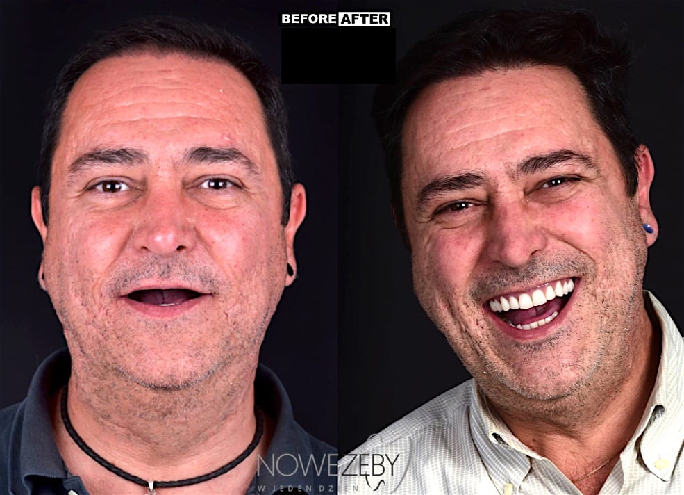 nowe zęby przed i po