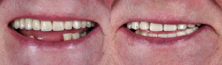 zęby po wszczepieniu implantów