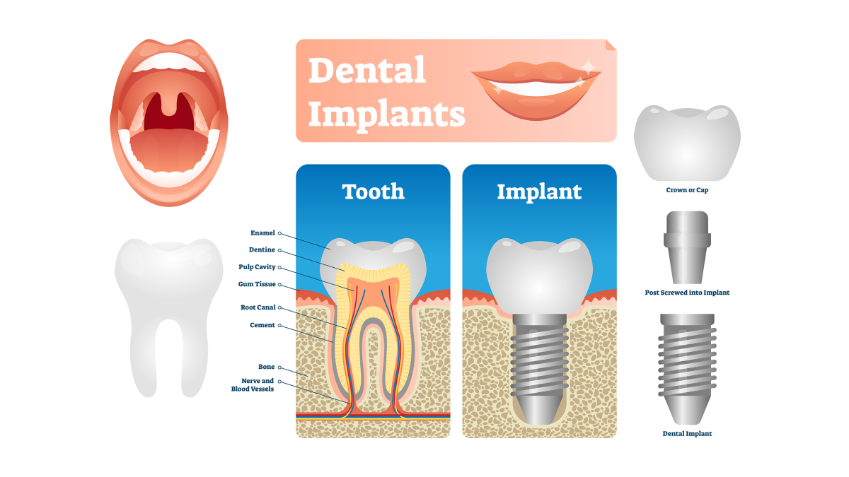 Schemat metody All-on-4 z wizualizacją analizy sztucznej inteligencji i planowania cyfrowego